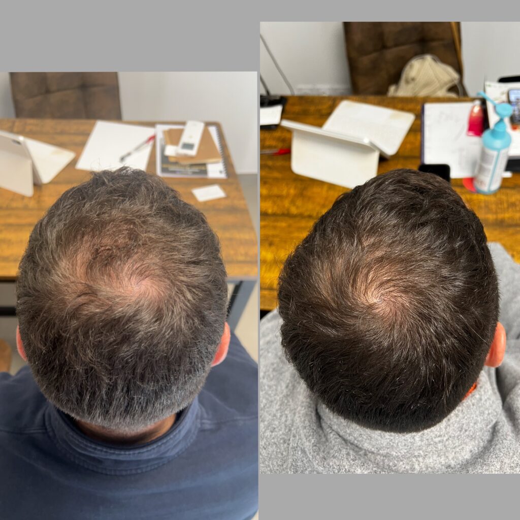 Avant après d'un traitement contre la perte de cheveux à Ollioules.