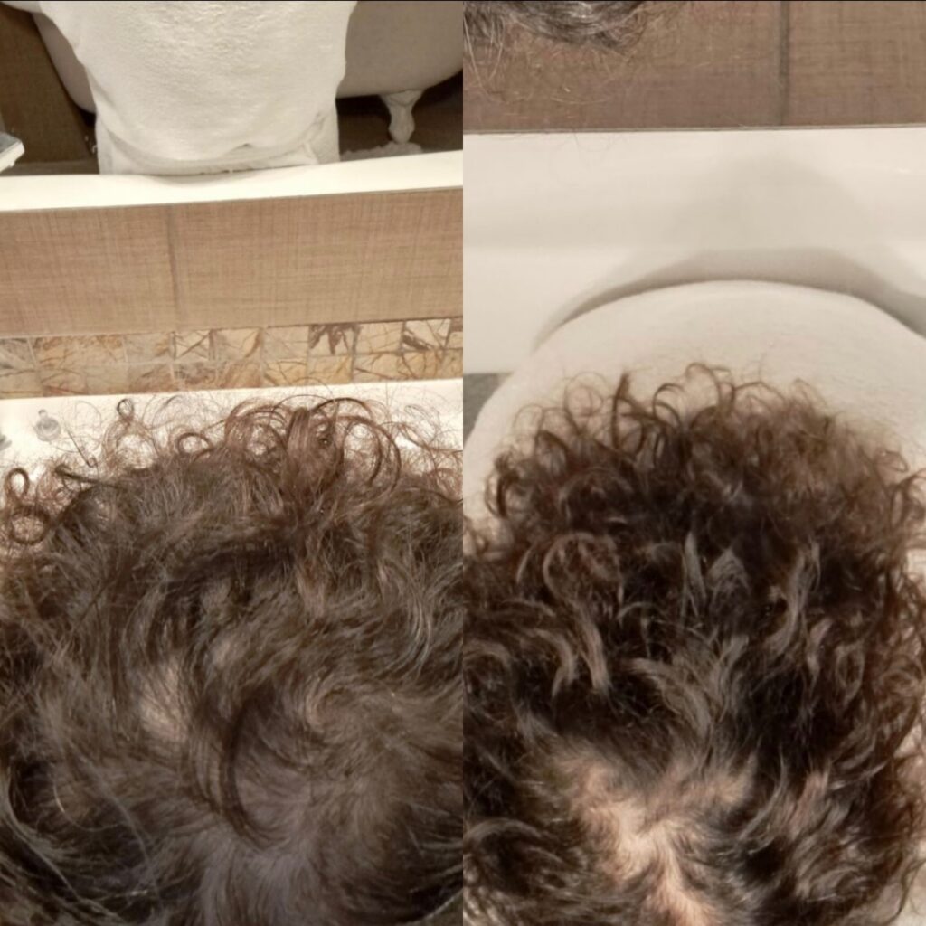 Avant après d'un traitement contre la perte de cheveux à Ollioules.