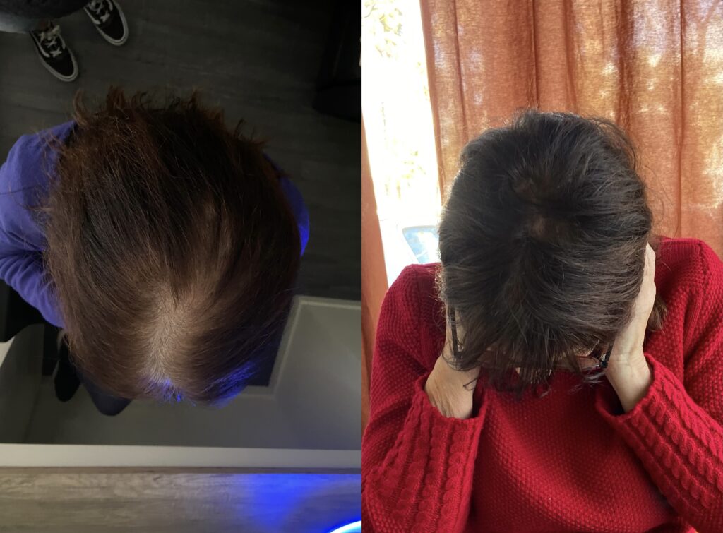 Avant après d'un traitement contre la perte de cheveux à Ollioules.
