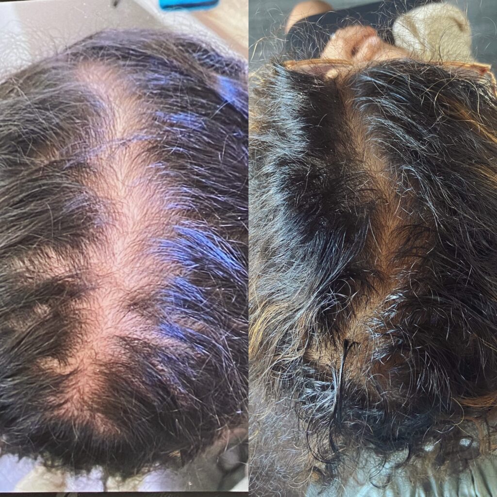 Avant après d'un traitement contre la perte de cheveux à Ollioules.