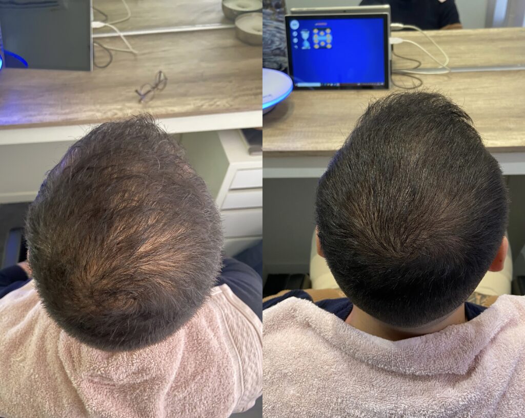 Avant après d'un traitement contre la perte de cheveux à Ollioules.